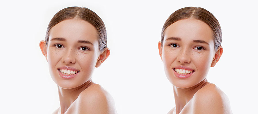 Otoplasty