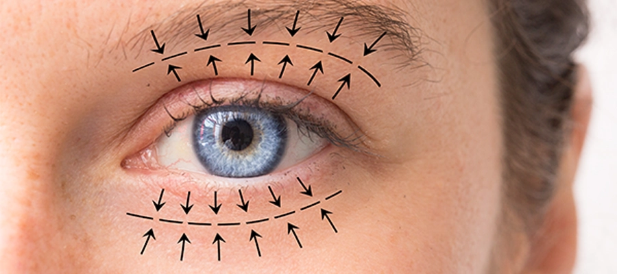 Combined Upper and Lower Blepharoplasty
