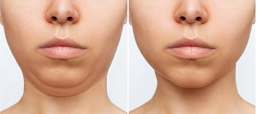 Liposucción de papada combinada con Endolift Endolaser del Dr. Fi