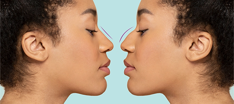 Ethnic Rhinoplasty
