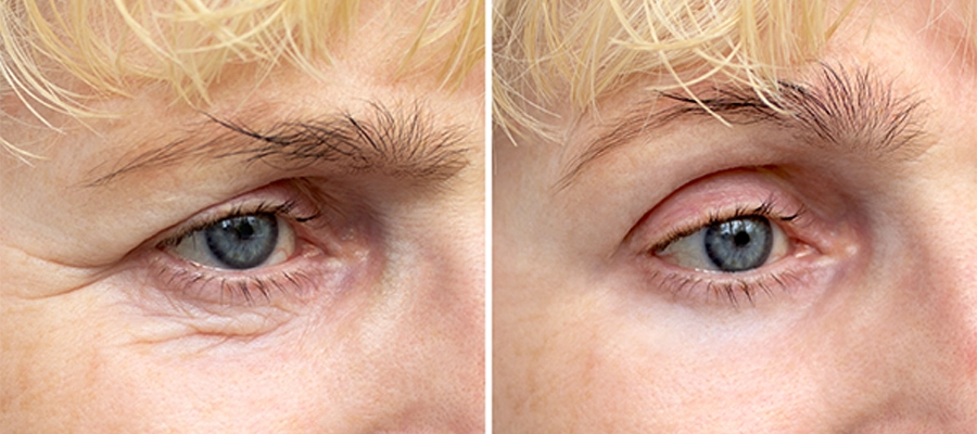 Lower Eyelid Fat Repositioning