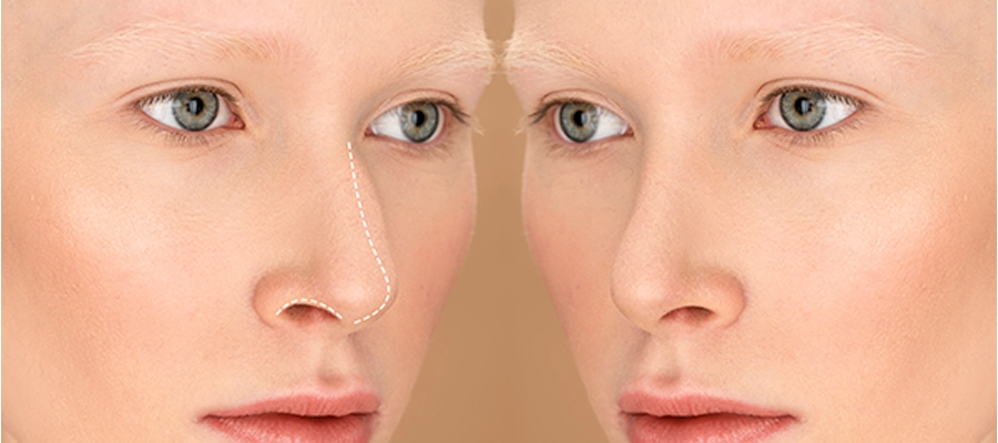Post-Traumatic Rhinoplasty