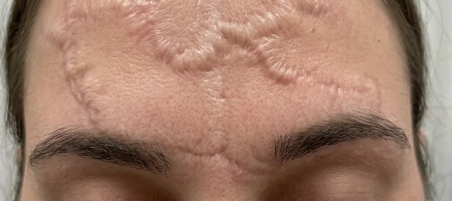 Post-Traumatic Scar Correction