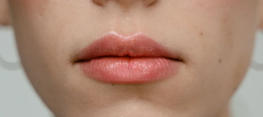 Subnasal Lip Lift Turkey