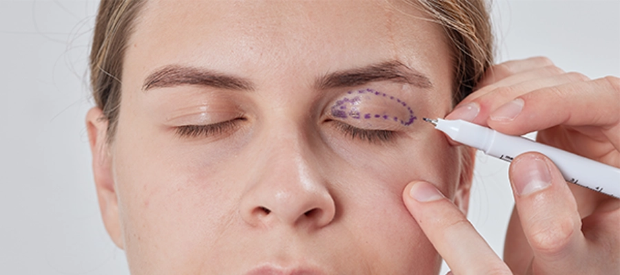 Upper Blepharoplasty